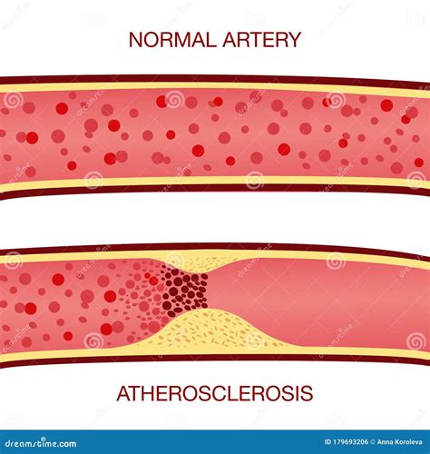 Placa De Colesterol En La Arteria Aterosclerosis Ilustración