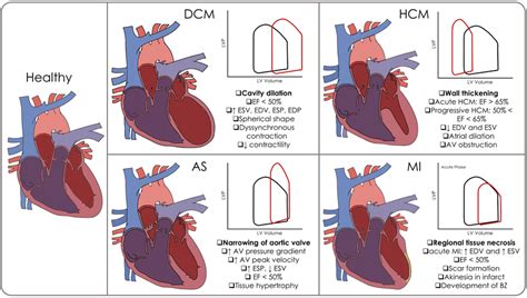 Illustration Of Cardiac Geometries Top Row And Pressure Volume Loops