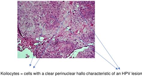 Histological Image Of A Verrucous Squamous Cell Carcinoma Of The Penis Download Scientific