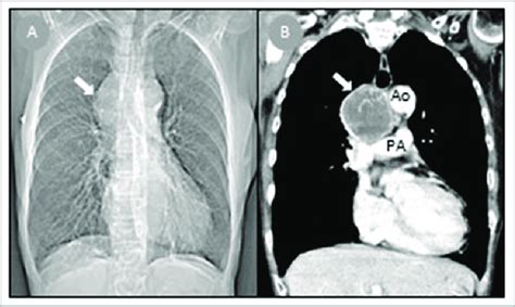 Chest X Ray A And Computed Tomography B Mediastinal Tumor Ao