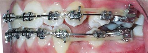 practical orthodontics comments  space closure