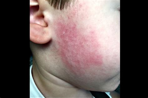 Itchy Raised Rash On Face At Nicholas Rose Blog