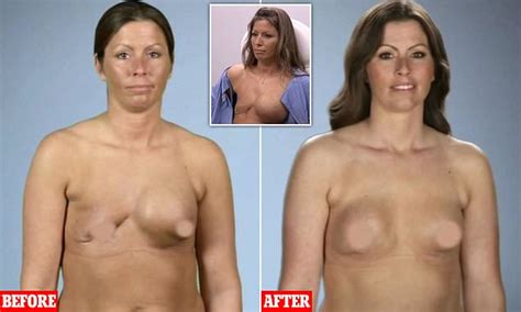 Woman S Relief After TV Surgeons Fix The Botched Boob Job She Had When Partners Cheated On Her