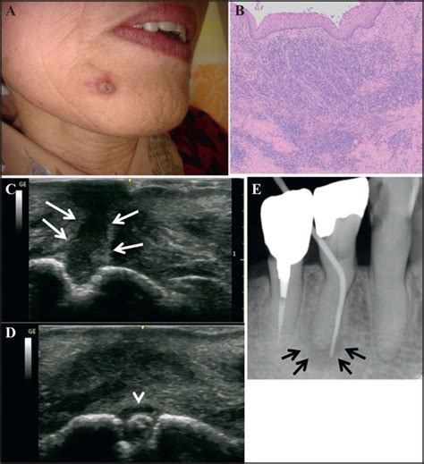 Usefulness Of Ultrasonography For Rapidly Diagnosing Cutaneous Sinus