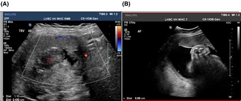 A Antenatal Ultrasound Image At Weeks And Day Gestation Showing A