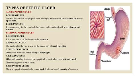 peptic ulcer disease pptx