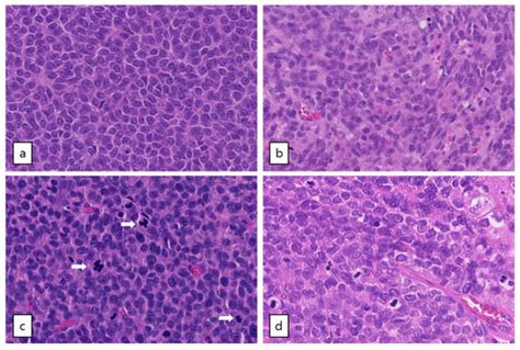 Cancers Free Full Text Whole Genome Analysis Of Ovarian Granulosa Cell Tumors Reveals Tumor