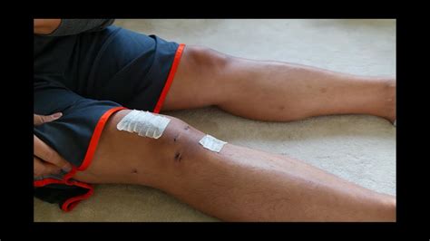 My Acl Surgery Recovery Quadriceps Tendon Graft Part 3 2 Weeks Youtube