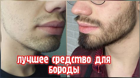 Миноксидил. Результат за 3 месяца. До и После. Minoxidil Kirkland 5% ...