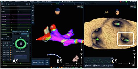 Po 05 210 Efficacy Of A Wide Band Dielectric Imaging System With The Cryoballoon Cb Occlusion