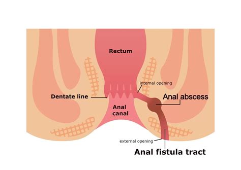 Anal Fistül Nedir Belirtileri ve Fistül Ameliyatı