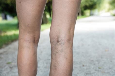 Varicose Veins — Vascular Associates Camperdown · Vascular