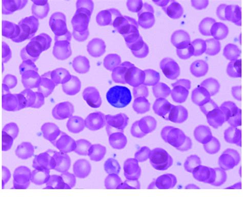 Morphological Examination Of A Peripheral Blood Smear The Smear Shows