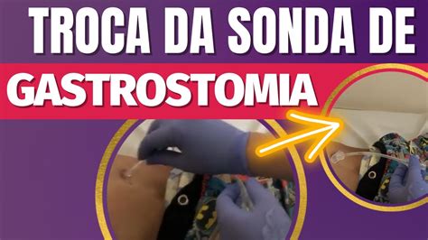 Sonda Gtt No Paciente - Gtt Botton Cuidados De Enfermagem - RETOEDU