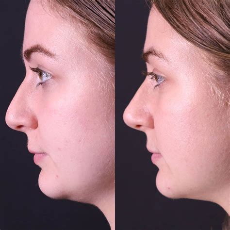 Non Surgical Rhinoplasty Melbourne