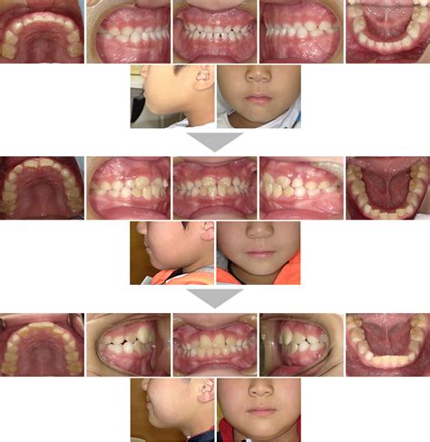 子どもの反対咬合の矯正治療例 愛知県尾張旭市の歯医者・歯科｜尾張旭駅10分のナガイ歯科