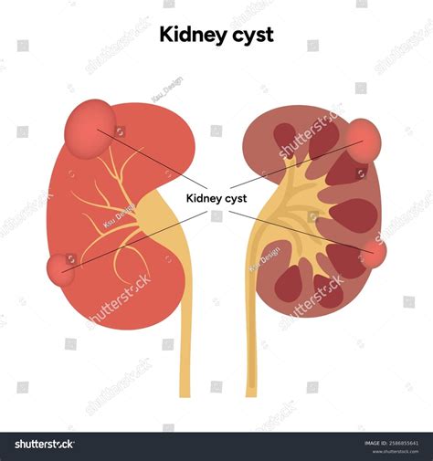 Kidney Cysts Polycystic Urinary Disease Renal Stock Vector (Royalty