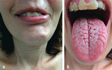 Fissured Tongue All You Need To Know Dentistmaa
