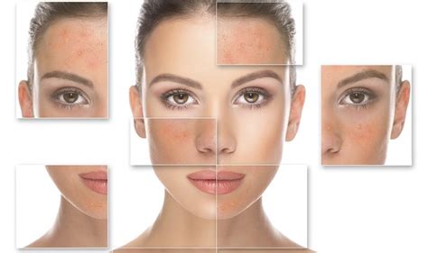 Кислотный пилинг для лица и кожи - виды, отзывы