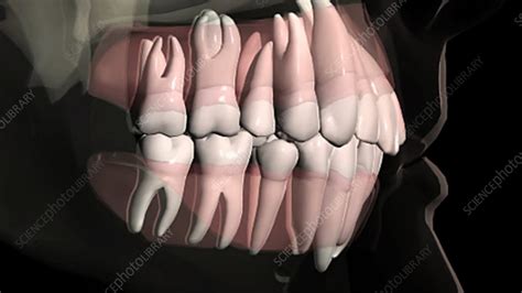 Overcrowded teeth - Stock Video Clip - K003/3688 - Science Photo Library