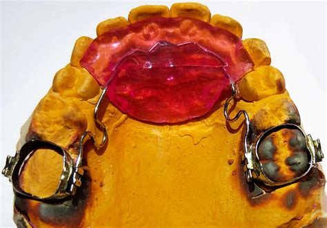 Пластиночные, двучелюстные, функциональные | Зубная Фея