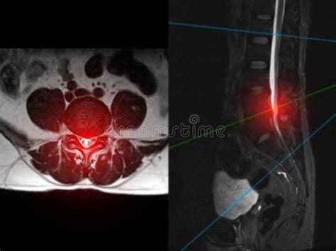 Lumbar Spine Mri Axial
