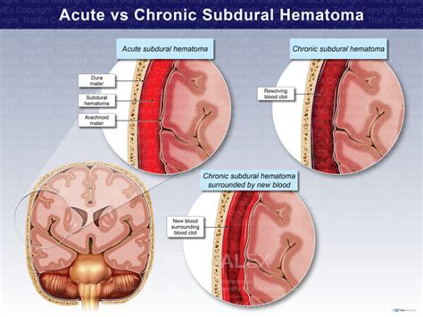 Chronic Subdural Hematoma Vs Acute