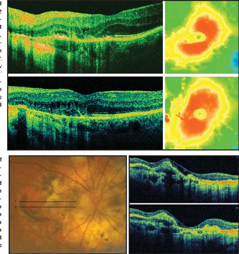 Figure 2 From Imaging Serpiginous Choroidopathy With Spectral Domain