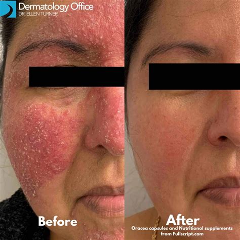 Acne Rosacea Before After