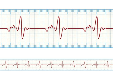 Easy Ecg Interpretation The Basics