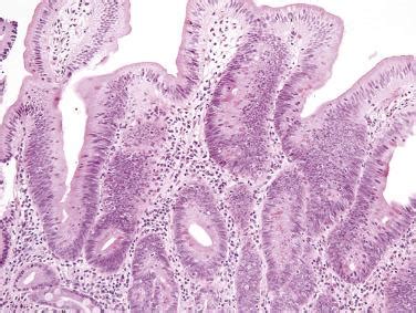 Tumors Of The Small And Large Intestines Including Anal Canal