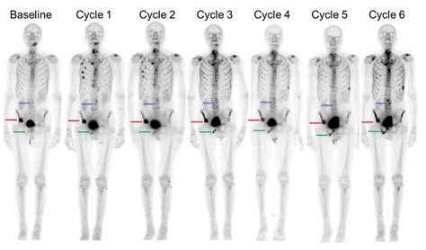A Treatment Paradigm Shift: Targeted Radionuclide Therapies for