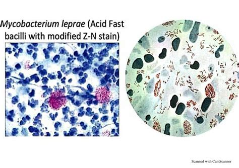 SOLUTION: Mycobacterium leprae bacteriology pathogenesis lab diagnosis ... 