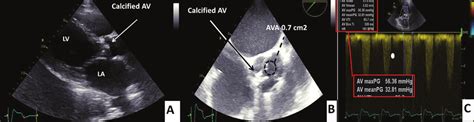 Severe Aortic Stenosis Echo