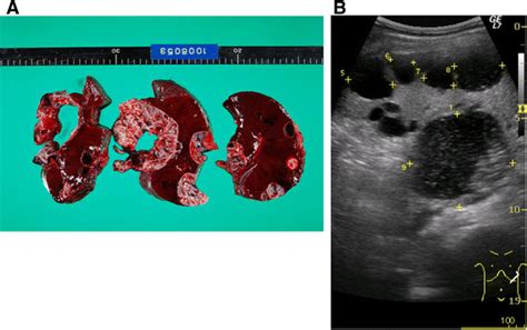 Clinical Features Of Splenic Epidermoid Cyst A Photograph Of The Download Scientific Diagram