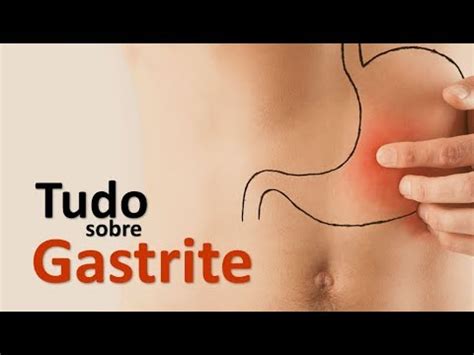 Tudo Sobre Gastrite Sinais Sintomas E Tratamento Dr Marcelo Lima