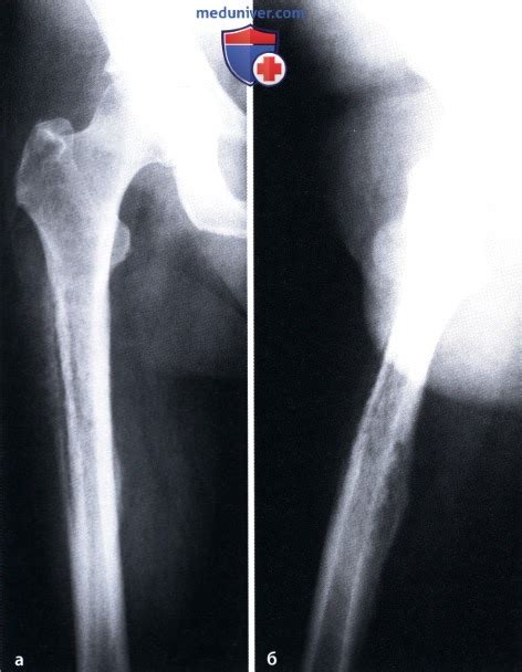 Острый гематогенный остеомиелит: атлас фотографий