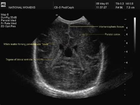 Neonatal Head Ultrasound Procedure And Images New Health Advisor