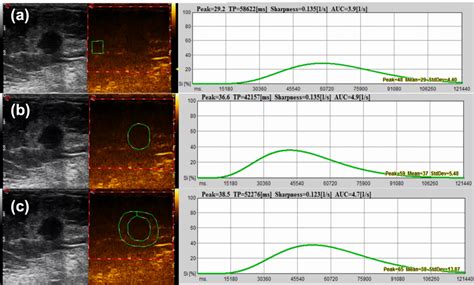 Contrast Enhanced Ultrasound CEUS Time Intensity Curve TIC