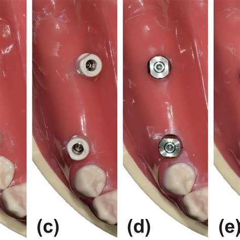 Strategies For Bone Tissue Engineering Through Surface Modifications On