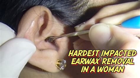 Hardest Impacted Earwax Removal In A Woman Youtube