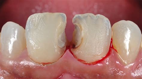 Dental Restoration | Hernandez Dental & Implant Center