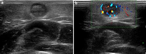 A Bump What To Do Next Ultrasound Imaging Of Superficial Soft Tissue