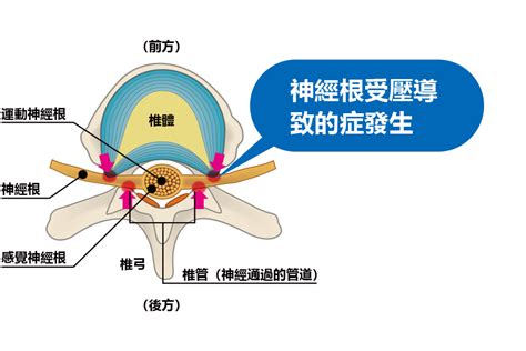 椎管狹窄症 原因、治療 Nlc野中腰椎醫院