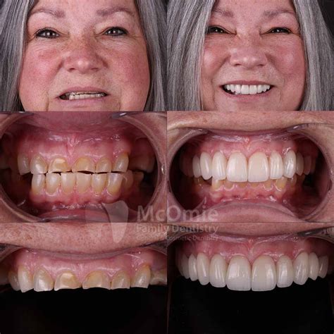 Options For Full Mouth Reconstruction Mcomie Dentistry Chattanooga