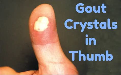 Thumb Tophi Worst Symptom Of Thumb Gout GoutPal Gout Help