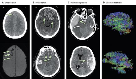 Traumatic Brain Injury Integrated Approaches To Improve Prevention