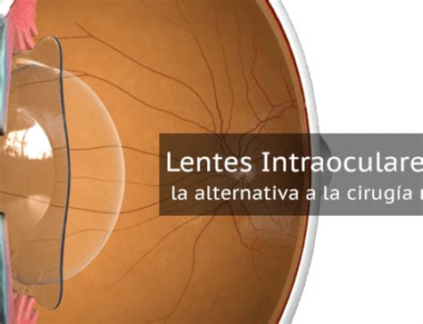 Precio De Las Lentes Intraoculares ICL