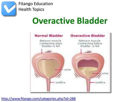 Overactive bladder