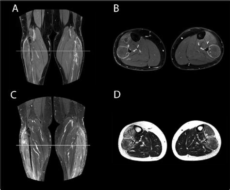 Magnetic Resonance Imaging Of Leg Muscles In Our Patient A And B Show